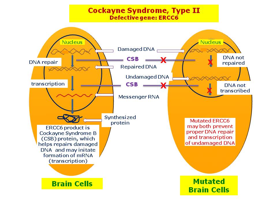 Cockayne Syndrome Type B Hereditary Ocular Diseases